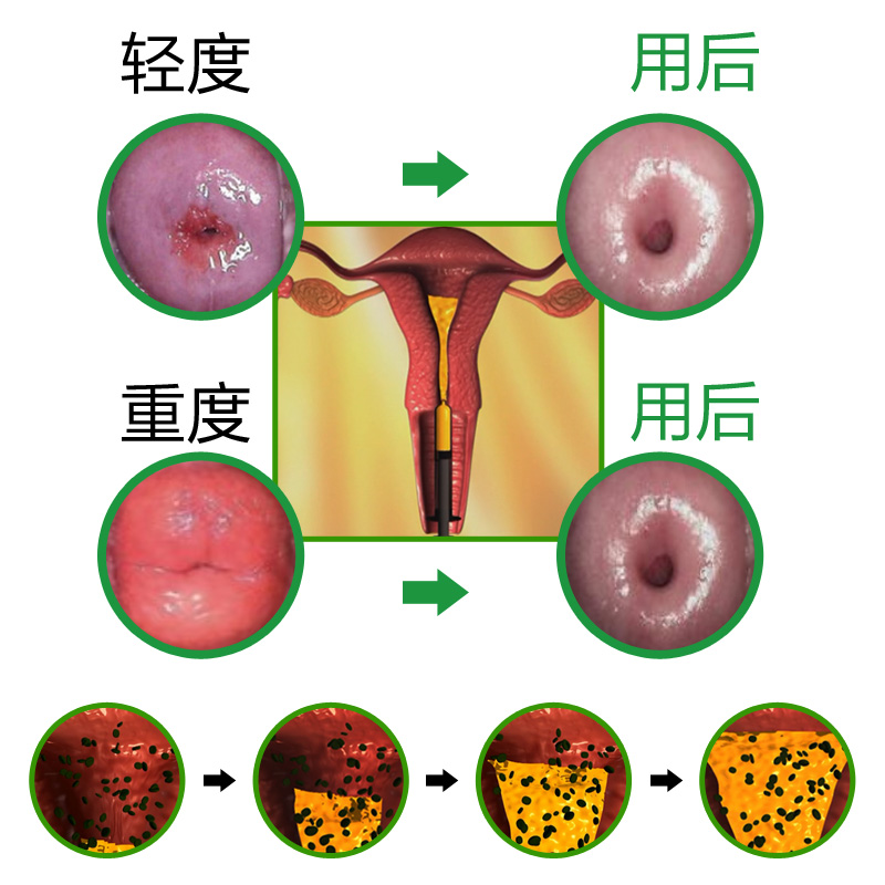 妇科炎症凝阴道炎凝胶治疗宫颈糜烂中重度用药盆腔炎霉菌滴虫性