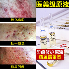 果酸祛ba印去痘坑凹om填充微针冻干粉正品神奇原液去痘精华液