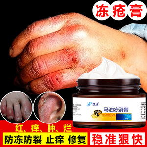 【去脚气脚臭脚痒脱皮达克宁价格】最新去脚气