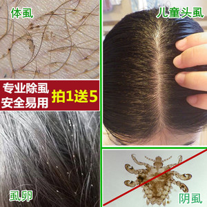虱子药一扫 span class=h>光头 /span>虱儿童喷雾去虱子粉除阴虱百部
