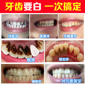 牙齿洁清素神器工具牙结石去除器洗牙牙石剔牙清除牙垢刮溶解家用
