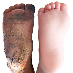 【7天无暇脱变】 护足 span class=h>霜 /span>脚后跟干裂 span class