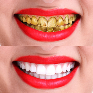 黄牙速效美白去牙渍牙贴图片
