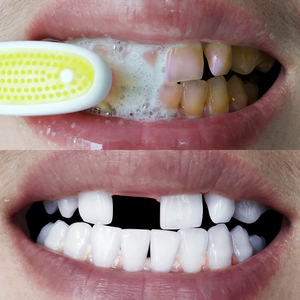 牙齿美白洗牙粉牙结石图片