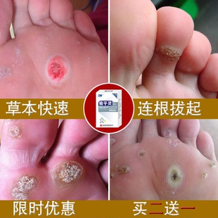 足部跖疣特效去除去疣灵老中医除尤净跖疣康膏拓疣寻常疣刺瘊肉猴